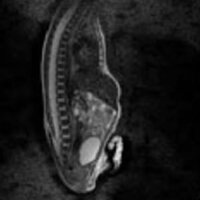 12-Channel Body Array Coil